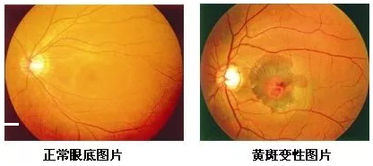 黄斑位于人眼底视网膜的中央,是视力 敏锐的部位,一般医生在测视力时