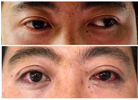 斜视专家潘美华教授亲临烟台为10复杂斜视患者实施手术